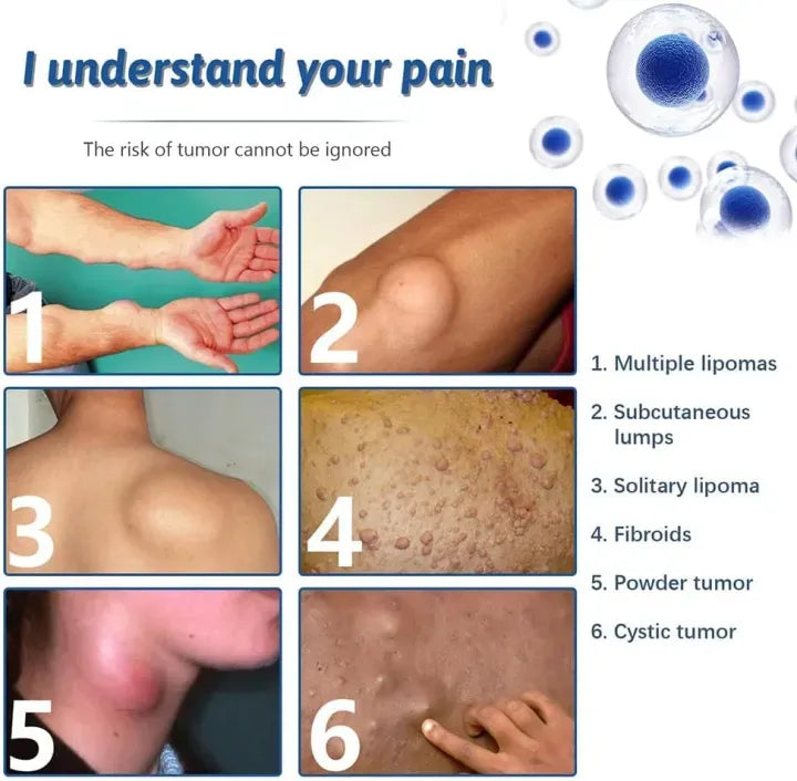 South Moon - Lipoma Removal Cream